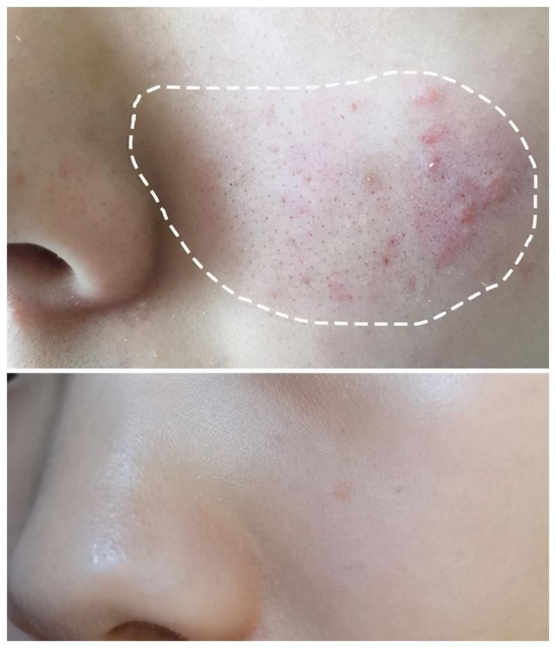 你真的懂刷酸吗？刷酸都有哪些好处？