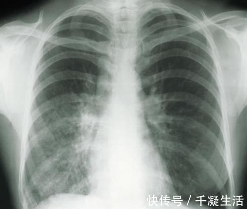 女子|女子双肺多发结节,一个已癌变!一旦查出这结节,建议尽快就医