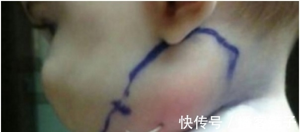 红肿|父母带着脖子突出一根东西的女婴去医院 一往外拉连医生都吓傻