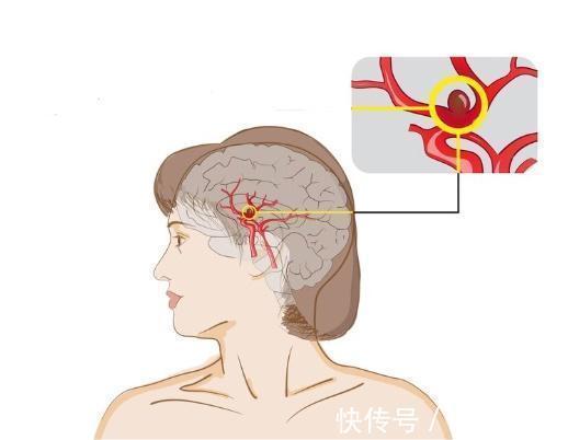 筛查|3大恶性肿瘤是癌症界的“伪装者”,身体一旦出现异常,及时筛查