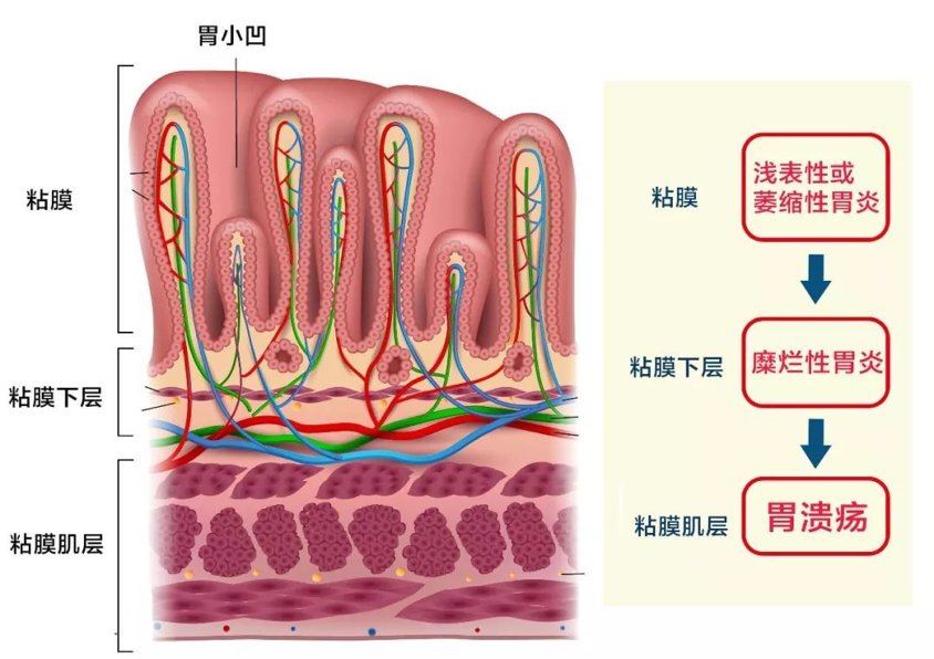 饮食习惯|糜烂性胃炎严重吗？医生：如不注意会引发胃溃疡，造成更严重后果