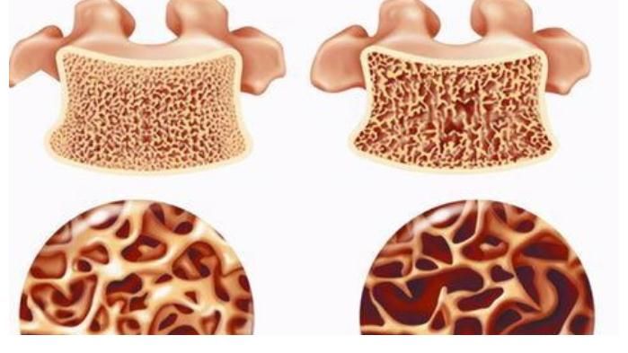 营养物质|医生提醒:3种食物或是骨质疏松“发物”,骨不好的尽量少吃