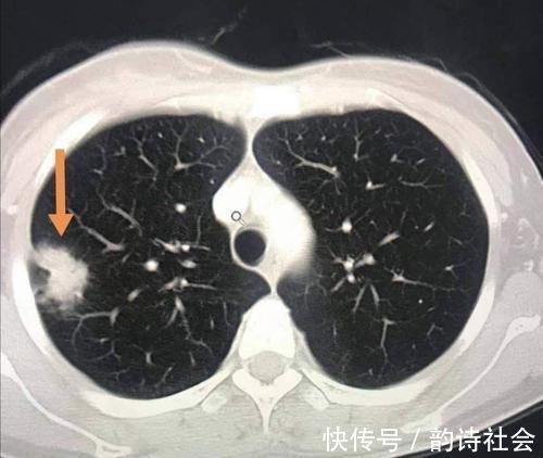 胸膜|癌症病人的幸运指数不一样，这位老太太想感谢一个吹破的肺大泡