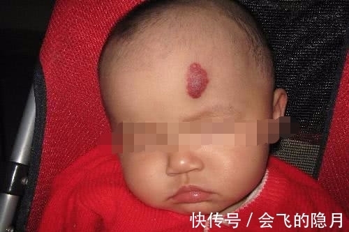 血管瘤|宝宝眉心有胎记,宝妈却不以为然,12个月宝宝送医抢救无效