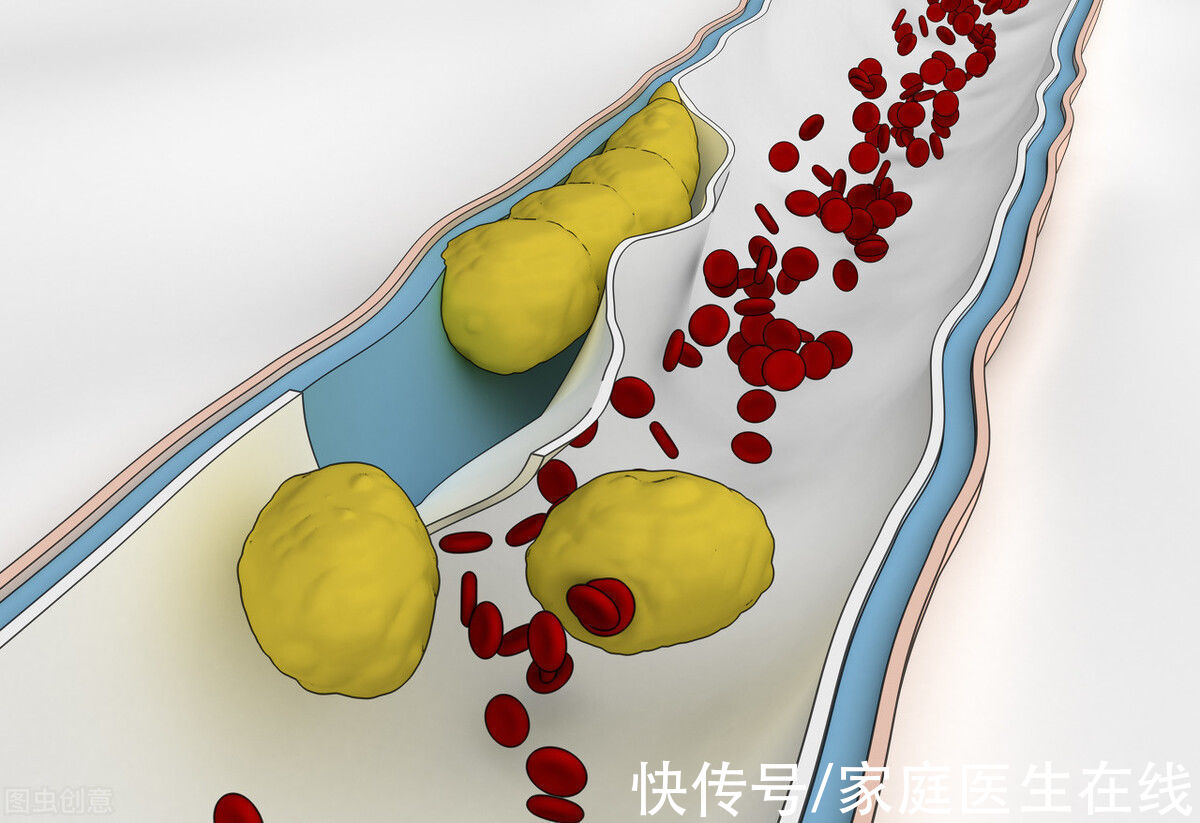 血管壁|血管变硬有多可怕？不仅如此，这2种血管问题也要命