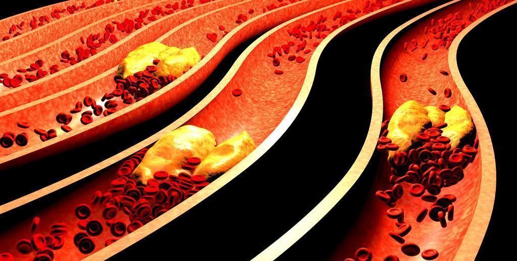 脑梗|50岁以上人，80脑供血不足，院士这1物多吃能通血管，赶走脑梗