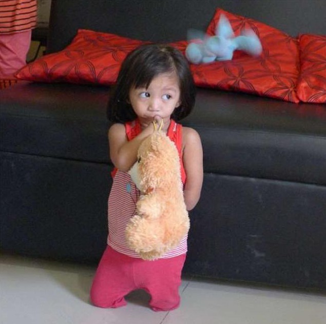 手术|女孩一出生就没有手脚,没有嘴,3岁才开口吃到第一口饭