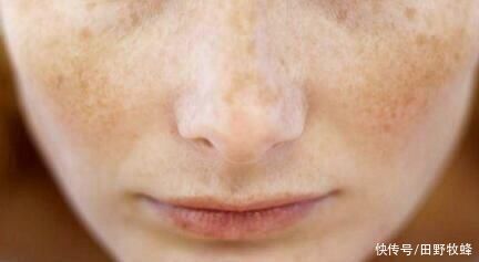 蜂蜜能淡化色斑吗？蜂蜜加什么可以祛斑美白？