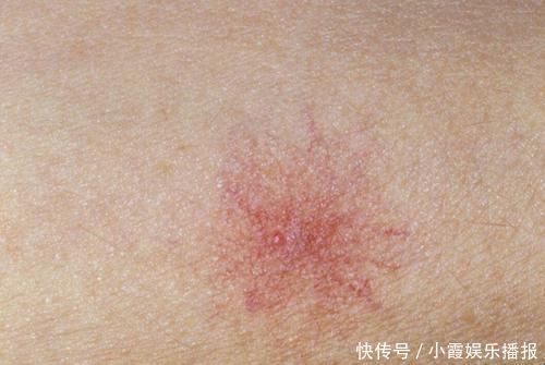 雌性激素|肝脏癌变身体会有信号吗?医生:有很多关键症状,占一个也要重视