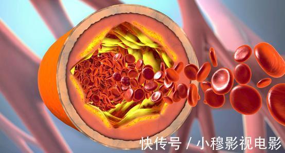 痛感|身上这4处疼痛,提示你血管堵了!做好这3件事,血管畅通身体健康