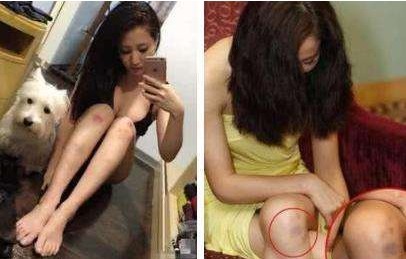 皮肤|身体一碰就淤青,可能患上了此3种病,男女都应该了解