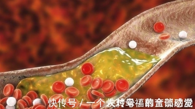 食物|茄子属于高血脂的“发物”吗？医生：预防高血脂，这3物尽量少吃