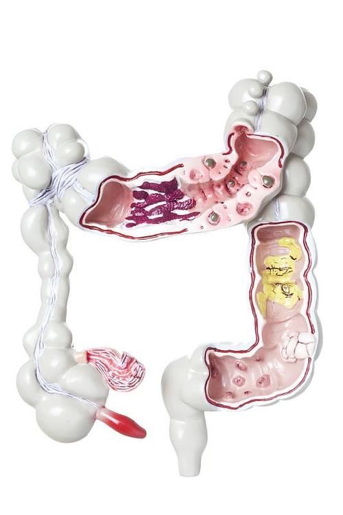 结肠癌|大肠癌的罪魁祸首已经找到，晨起坚持三个习惯，肠道才会更健康