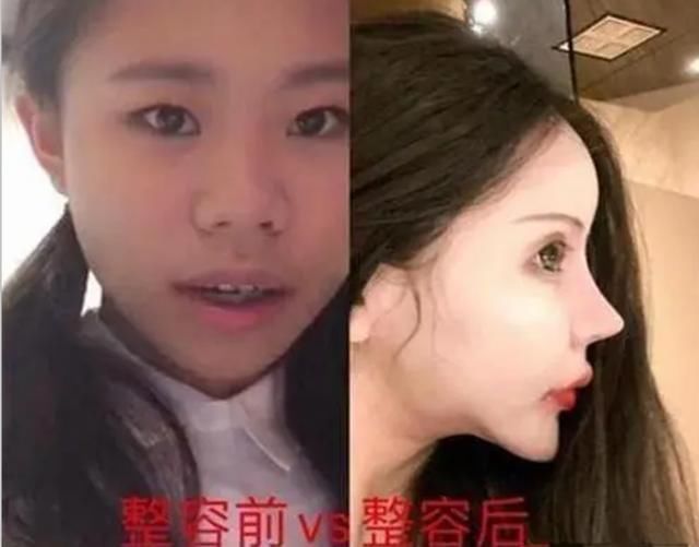 小姑娘|13岁女孩“沉迷整容”，3年整60多次，如今五官留下这么多后遗症