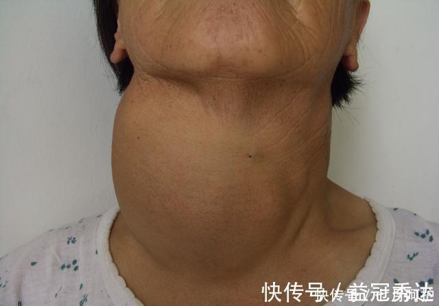 医生|查出甲状腺结节,不能碰“海鲜”?医生:真正不能吃的是这两物