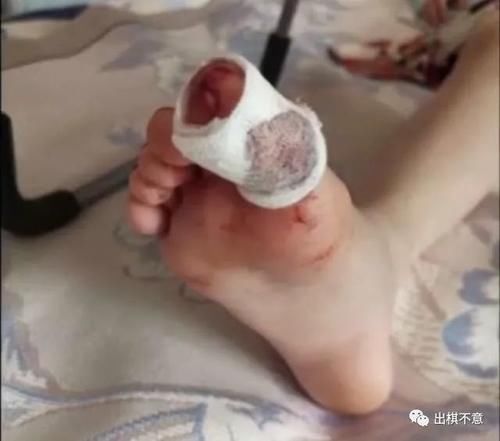脚趾|女孩学游泳不慎受伤,治疗费用花了一百多,家长却要索赔三万五