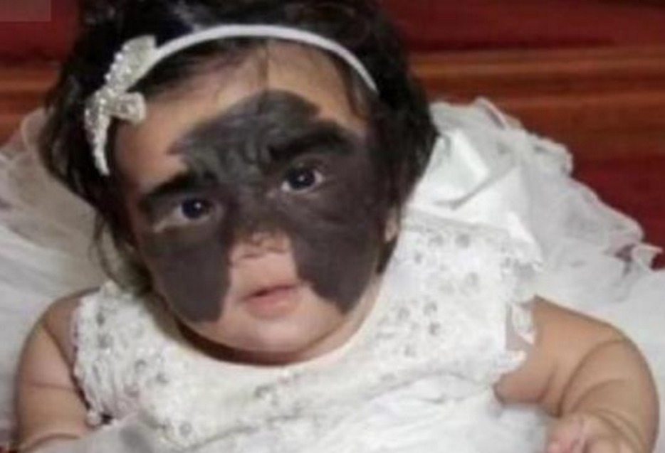 蝙蝠侠|女婴一出生伴随“蝙蝠侠印记”,被父母送去整容7次,结果怎样了