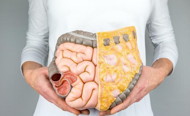 排出体外|放屁时若有这种“表现”,或许是“大肠癌”发出的信号,早知早好