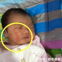 宝宝|宝宝一个月了，脸上的产钳印还没消，婆婆的一句抱怨让妈妈火了