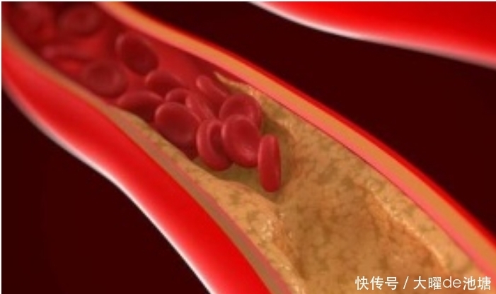 血脂高|血脂高的人,尽量“少吃2酱、多喝2水”,可能血脂“平稳下来”