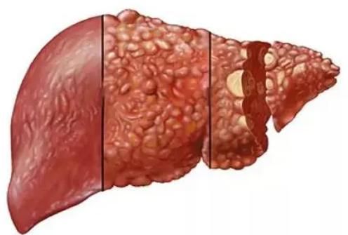 张大哥|43岁男子滴酒不沾，确诊肝癌，化疗4次离世，医生：这2物怎能常吃