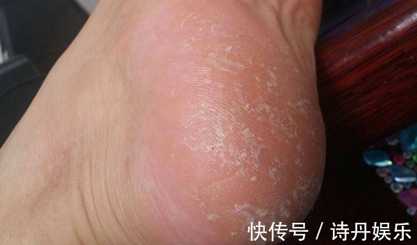 黑棘皮|血糖太高，皮肤不会说谎，皮肤出现以下表现，或是糖尿病找上门了