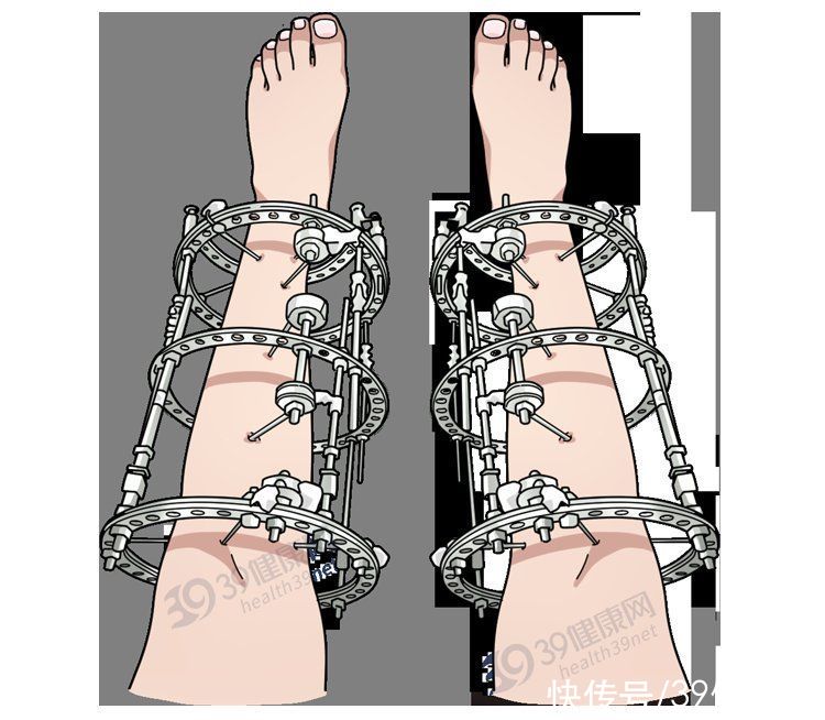 髓内针|做了断骨增高术的人，最后都怎样了？一旦失败，这3个后果在等着