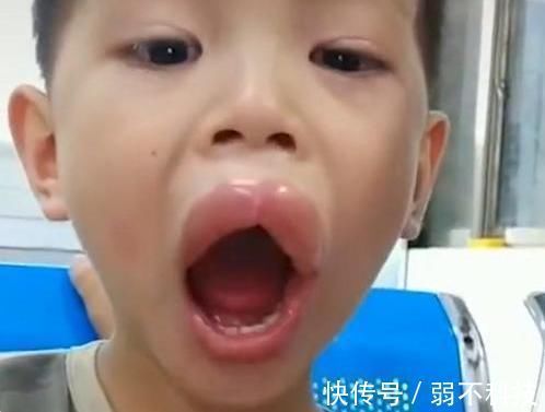 香肠嘴|熊孩子偷吃了一颗葡萄,嘴巴变成了香肠嘴,医生看了都憋笑