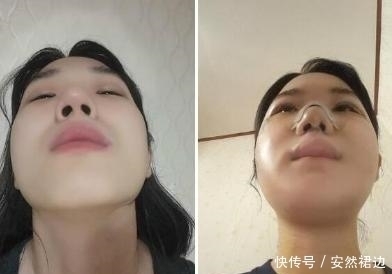 小脸确实更可爱,看完整容过程,只觉得满屏的疼痛