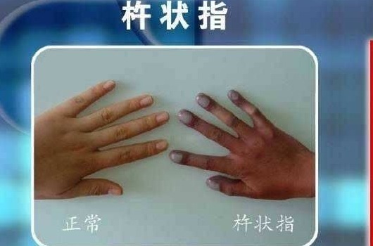 检查|24岁男子肩膀痛,查出肺癌,提醒:身体有2痛1粗,最好检查下