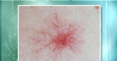 肝硬化患者,身体如果没有3个“症状”,恭喜,证明肝脏在好转