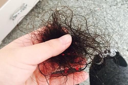 一挠头皮，指甲缝中都是白泥？医生：可能不是头皮屑，要上点心