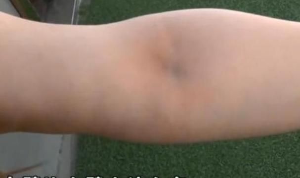 女子|妙龄女子花6万整容,如今脸上天天挂着注射器,医院:赔你13000元