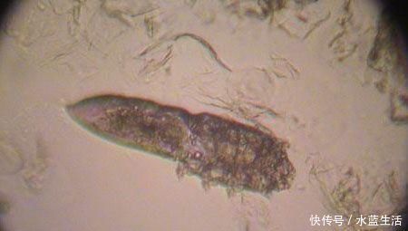 三种现象证明你脸上长了螨虫,还在用醋洗脸吗,难怪没效果