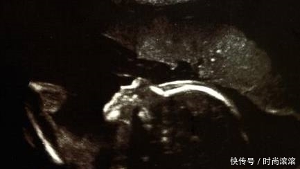 到底|葡萄胎到底是什么?怀孕期出现葡萄胎该怎么办?