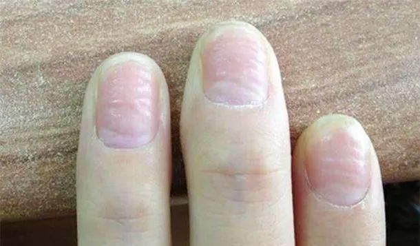 中指|手有这“4种变化”,提醒你“大病”来了,需尽早就医,千万别拖