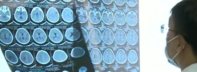 血管瘤|4岁女童头上的胎记,一查竟是血管瘤,医生给出了答案