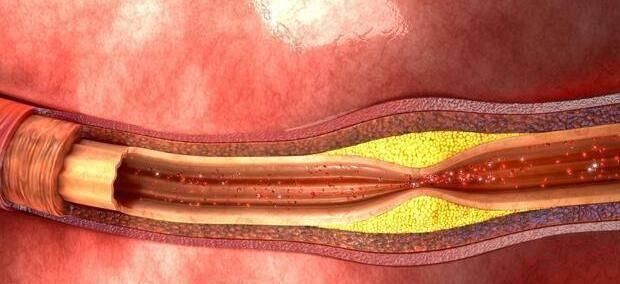 医生|医生甘油三酯过高只是预示,看专家怎么吃,降血脂快