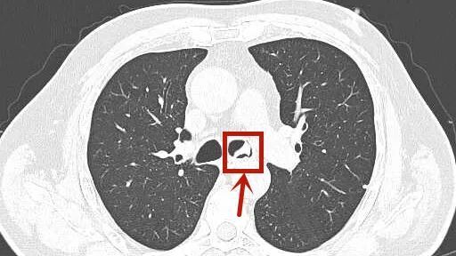 支气管|消失的假牙钩在气管上,杭州大伯“心肺都要咳出来”!这些动作不要再做了!
