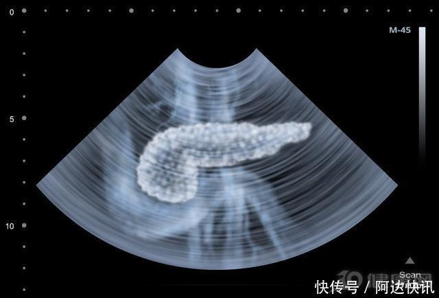 癌症之王!若持续有这三种感觉,短期内胰腺癌可能会来