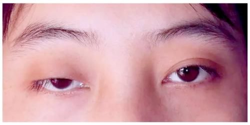 逼疯强迫症的一单一双眼皮，手术能不能只做单侧？