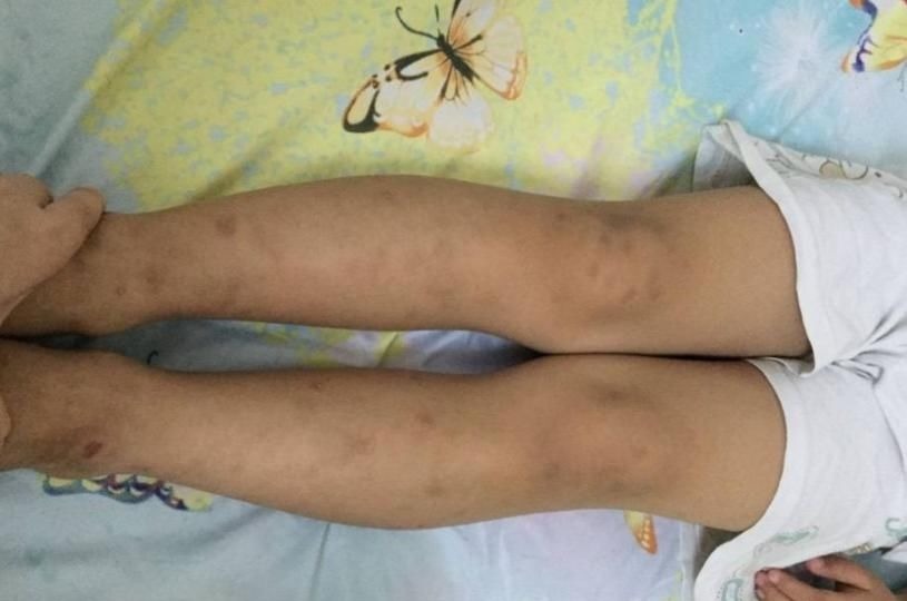 骨骼|孩子缺钙时,身体会出现4种信号,多给孩子吃3物,补钙质长个高