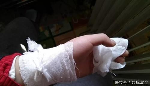 纽扣电池|孩子被开水烫伤,先脱衣服还是先冲水顺序做错伤情更严重