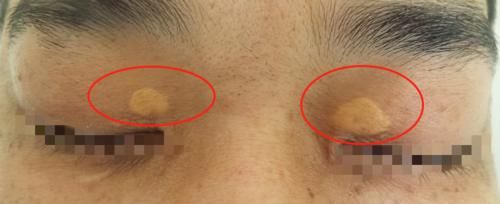 血脂|查出高血脂，还能继续吃蛋和肉吗？