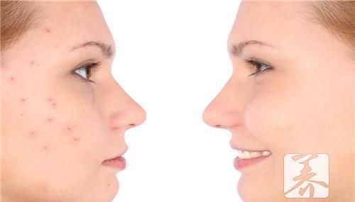 脸上疤印怎么消除