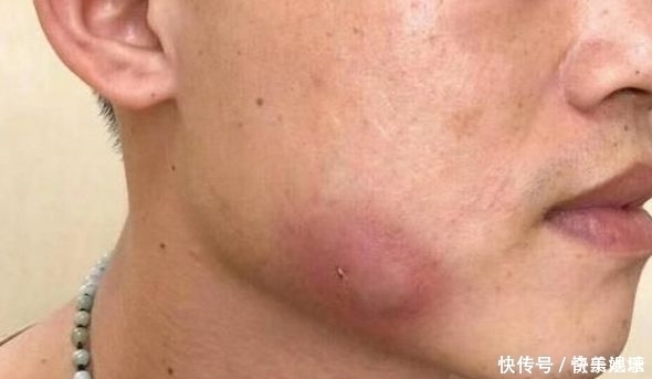 痘痘|小伙脸上慢慢鼓起大包，去医院检查，拍完的片子让医生很意外
