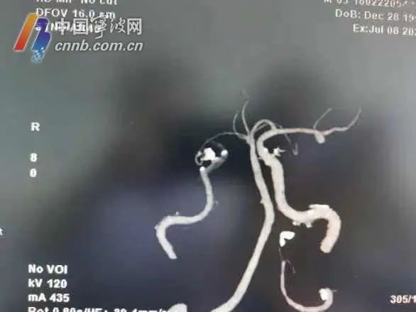 心脑血管|注意！夏天这个行为易导致脑梗死，宁波一医院近半月收治了16例