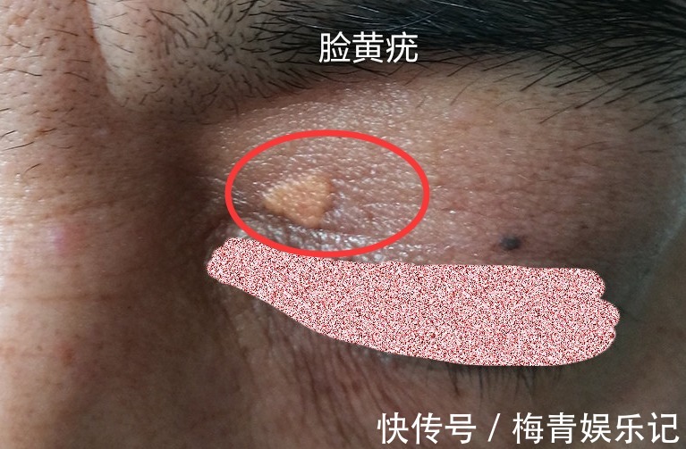 甘油三酯“大户”被揪出,并非猪肉,医生:不想脑梗逼近,要忌口