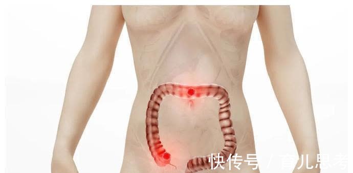 卵巢癌|癌症在发作前2年征兆，放到圈子很多人会感激你一辈子！