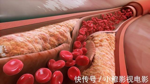 脂肪含量|什么饮食清淡,血脂还是高?提醒:这3个“饮食误区”,别再犯